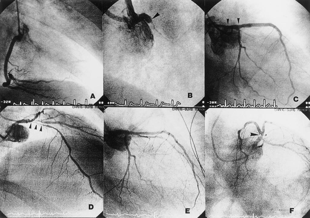 Figure 1. Patient 11. A right coronary angiogram (A) demonstrated a normal and dominant RCA without intercoronary collaterals.