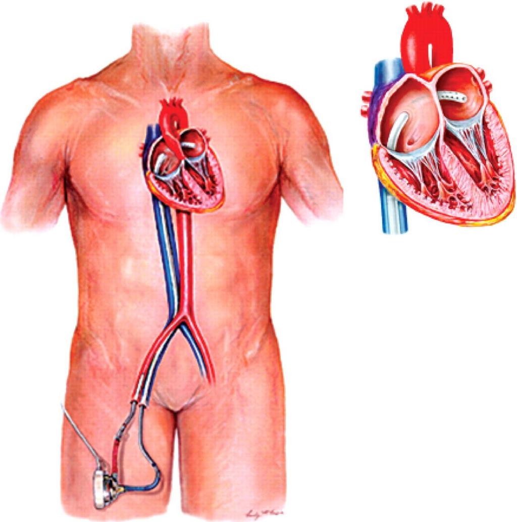 Left atrial-to-femoral arterial LVAD Low speed