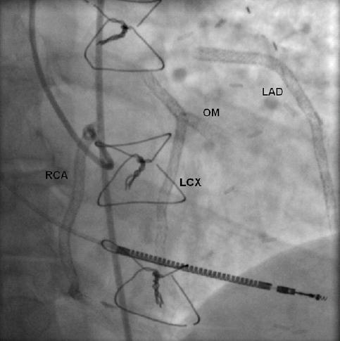 A Heart with 67 Stents Plain Old Balloon Angioplasty 1977 Bare Metal Stent 1986 Drug Eluting Stent