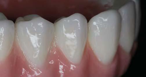 32 Following are examples of zirconia hybrid denture bridges with no facial layering. Figs.