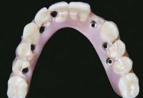 While this traditional design has been successful, it is well known that the acrylic denture teeth are highly susceptible to breakage and occlusal abrasion. Figs.