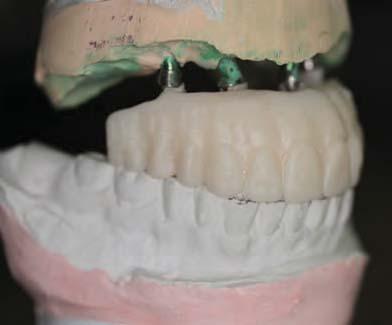 The zirconia specialty lab will fabricate a resin duplicate of the acrylic hybrid denture. Fig.