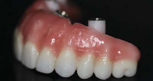This gingival colored porcelain is specially formulated with a thermal expansion coefficient value of 9.6.