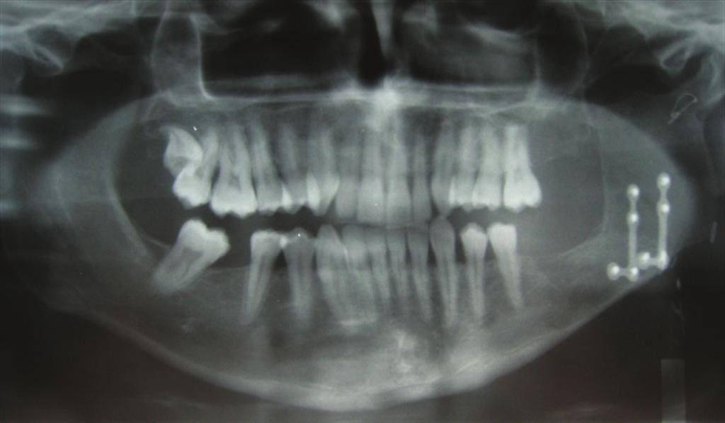 In 30% of the mandibular cases the tumour involved more than one anatomical area, most frequently affecting the body, angle and vertical ramus [10%].