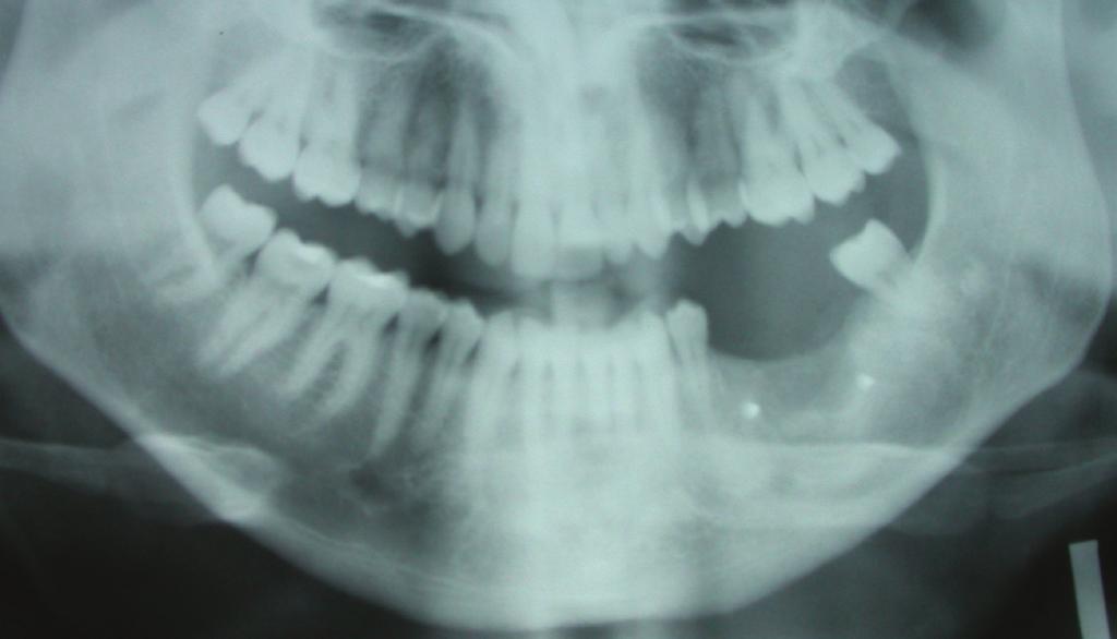 Fig. 6. Recurrence located in an iliac crest bone graft on the left mandible molar area.