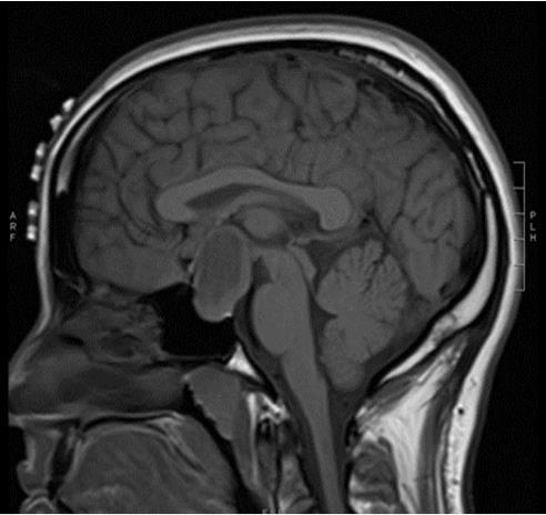 Figure 1- Pre-operative MRI Figure 1a.