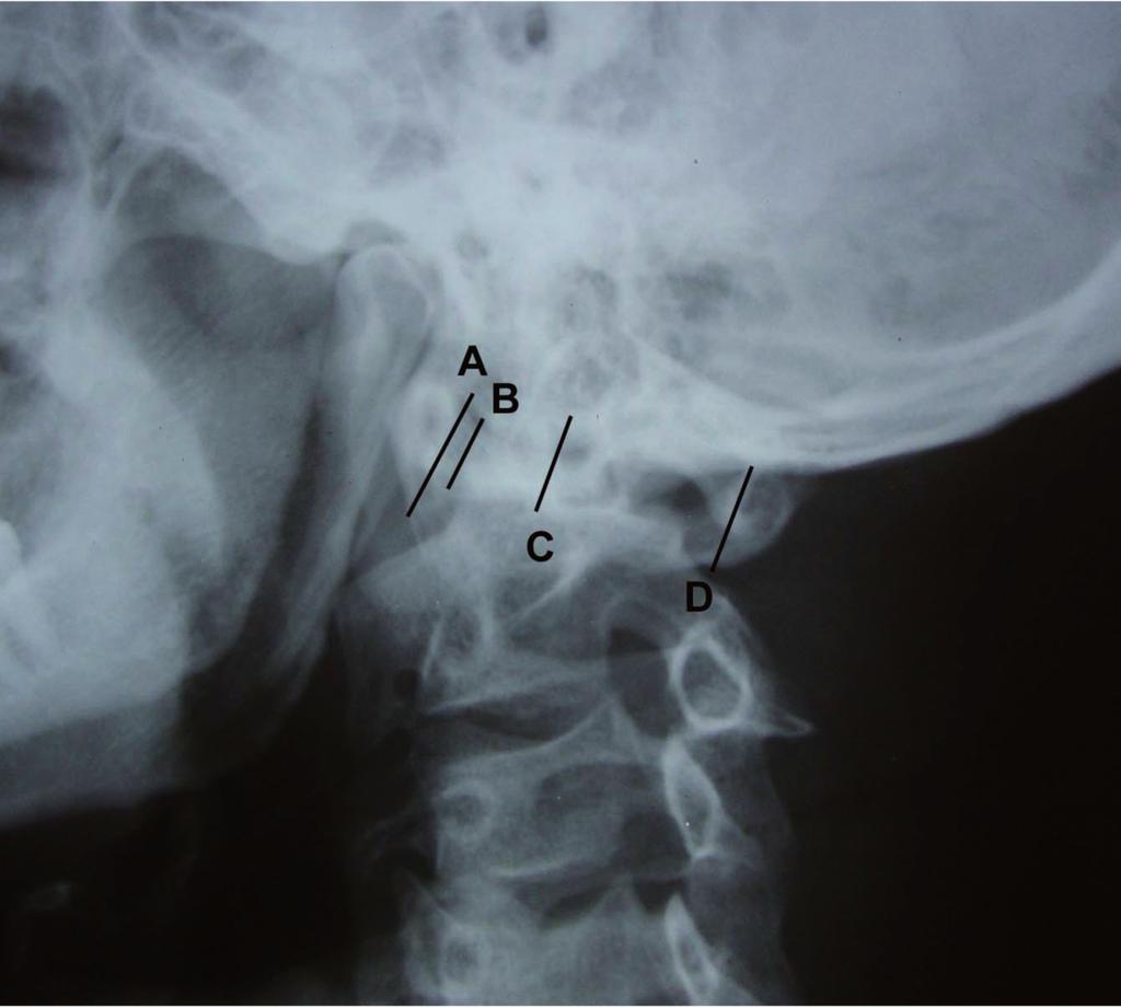 Maximal rotation at atlanto-axial joint: analysis of changes in mid-sagittal space within atlas vertebra Fig. 1A. Antero-posterior view of the cervical spine with the neck in axial rotation.
