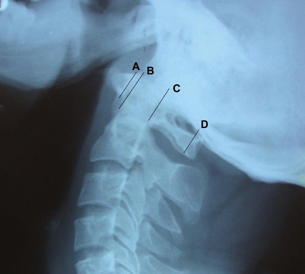 Lateral view of the cervical vertebrae without any rotation. A to B= AS; C to D= PS. surface of the dens up to the anterior aspect of the posterior arch of the atlas (PS) (Figs. 1a, 1b).