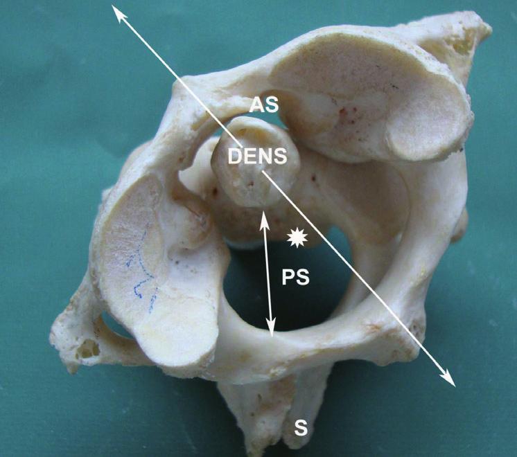 Descriptive statistical values were compared between the results obtained from each individual before and after rotation at the atlanto-axial joint.