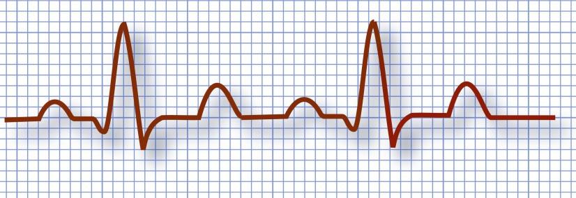 EKG (Electrocardiogram) Your heart sends an electrical impulse through it each time it beats.