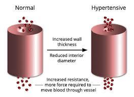 Hypertension vs.