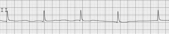 26 J. Gallagher and C. Tompkins Figure 2.7 Junctional rhythm. No p-waves are present and the distance between each QRS complex (R-R interval) is fairly regular Figure 2.