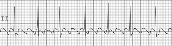 These p-waves reflect continuous atrial activation and often occur at a frequency of around 300 bpm. These waves are called flutter waves, and the rhythm is known as atrial flutter (Fig. 2.8 ).
