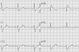 Right Axis Deviation Normal Axis LEAD III LEAD AVF LEAD II 90 120 90 60 In left axis deviation, the axis of the heart is from 30