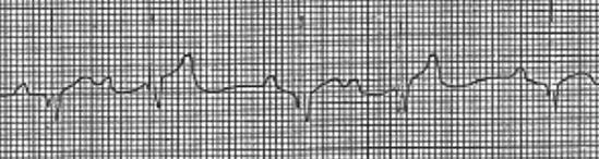 19 Second degree AV block, type II the PR interval is fixed but intermittently the AV node does not conduct to the ventricle which results in a missing QRS complex The next interval to evaluate is