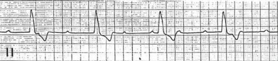 Chapter 2. Evaluation of Heart Rhythms 35 Figure 2.20 Third degree AV block more p-waves than QRS complexes and no regular intervals between the p-waves and the QRS complexes VI I Figure 2.