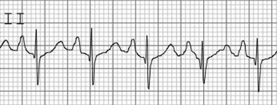 38 J. Gallagher and C. Tompkins Figure 2.24 Right atrial enlargement manifested by tall p-waves Figure 2.