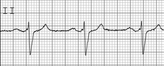 Since the atria do not typically hypertrophy, this increased p-wave size represents increased volume.