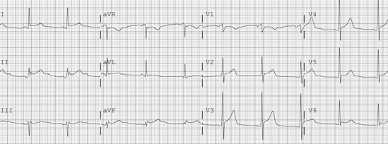 Chapter 2. Evaluation of Heart Rhythms 39 Figure 2.26 Pericarditis: PR depression and diffuse ST segment elevation of the t-wave and the beginning of the p-wave.
