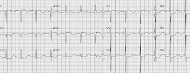 A posterior infarct is more difficult to diagnose but can present with large R waves in Leads V1 and