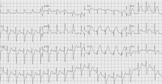 42 J. Gallagher and C. Tompkins Figure 2.31 Posterior myocardial infarction Figure 2.