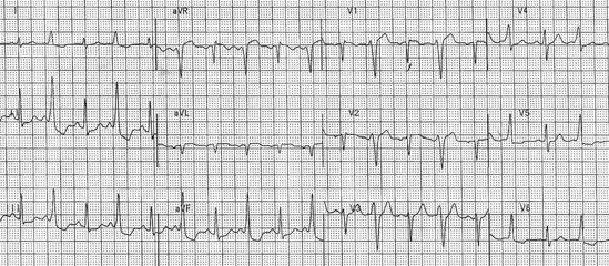 Chapter 2. Evaluation of Heart Rhythms 43 Figure 2.33 Inferior ST depressions Lastly, the t-waves and u-waves can be evaluated.