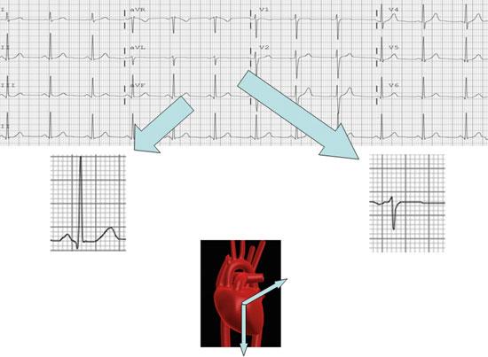 18 J. Gallagher and C. Tompkins The same heart beat is seen differently by leads AVL and AVF.