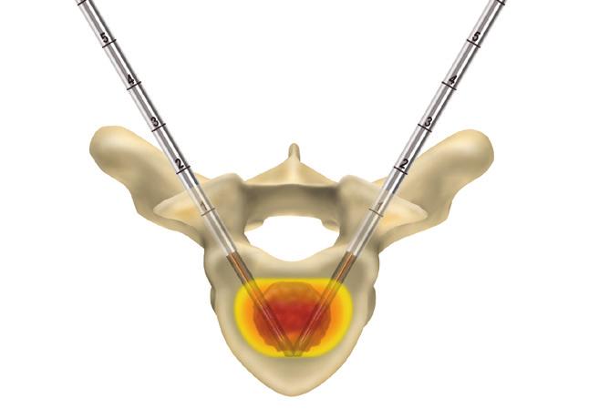 your patient and procedural needs OsteoCool RF ablation
