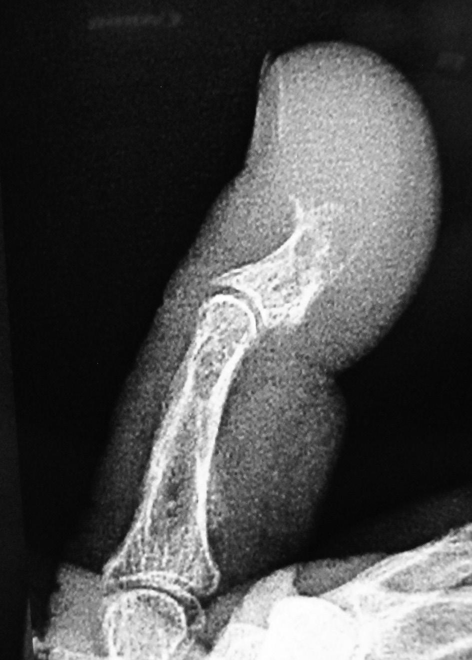 Anteroposterior Radiographic View of the Distal Phalanx of the Thumb Showing