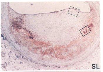 Metalloproteinase and Gelatinolytic Activity of Human Coronary Artery Atherosclerotic Plaques Adventitia Media Internal Elastic Lamina Fatty Streak/Plaque VASCULAR BIOLOGIST'S