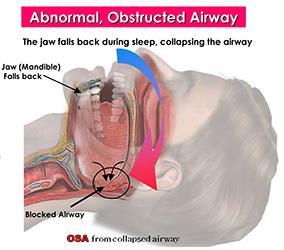 obstruction occurring during sleep o Result in