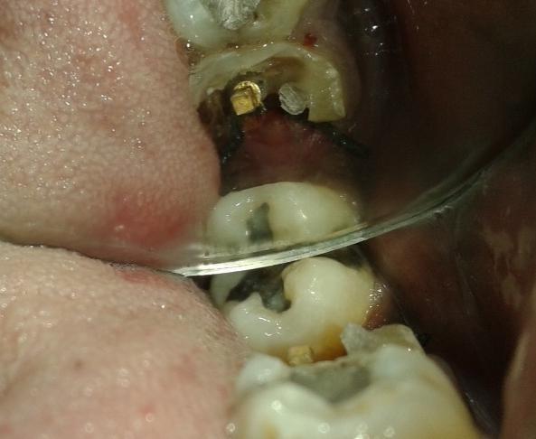 After healing post space prepared with respect to mesial root, postwasluted with resin cement followed by core build up and tooth preparation for full coverage crown (figure 5, 6).