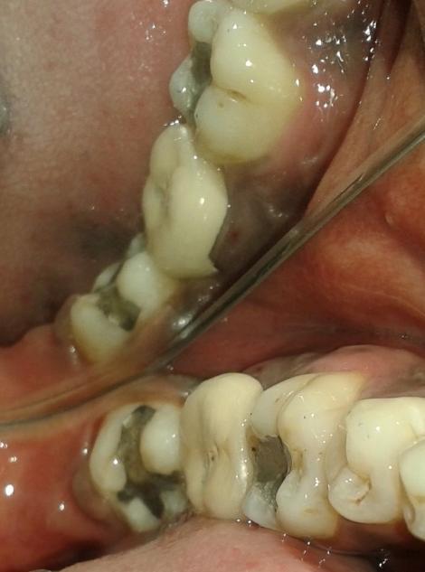 Lesions which extend up-to furcation area of tooth, many factors such as tooth anatomy, crown root ratio, severity of attachment loss, occlusal relationship, medical status of patient, patient oral