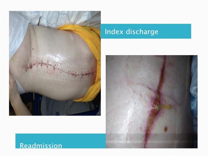 Discussion - Results of Vacuum Dressing Duration of vac therapy 4 / 52 3 / 12 Follow up 14 / 12 41 / 12 Wound closure