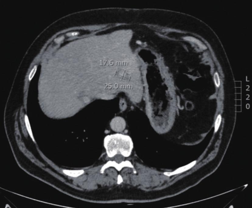 atypical carcinoid, previously treated with surgery and SSA. The 68Ga-DOTATOC PET/CT (A, maximum intensity projection image) shows elevated SSR expression in the tumor lesions (B, baseline CT).