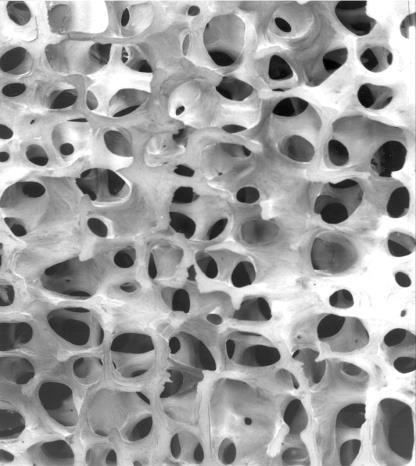 Osteoporosis A systemic skeletal disease characterised by low bone