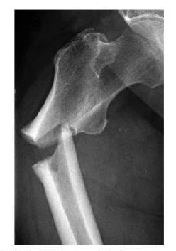 ATYPICAL FEMUR FRACTURES Absolute risk of 3.
