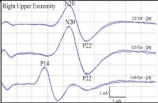 Channel Considerations If C5Sp-FPz channel is used, a collection of N13, inverted P14 are consolidated into one larger waveform Channel Considerations Usefulness of two peripheral potentials: