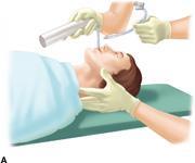 Manual in-line stabilization Head and neck in neutral position Assistant Head of bed: Grasp the