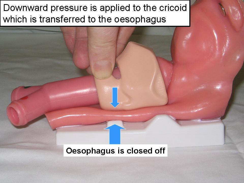 Cricoid pressure To prevent