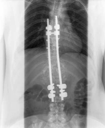 L1. Spinal