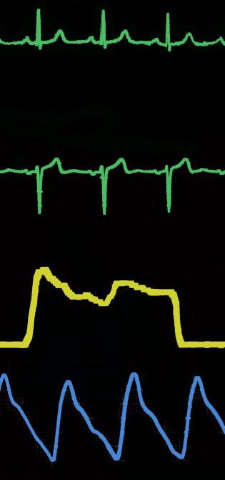 For Peer Review Fig 1: Telemetry showing biphasic capnograph (yellow), pulse oximetry (blue) and electrocardiograph (green) after single lung and