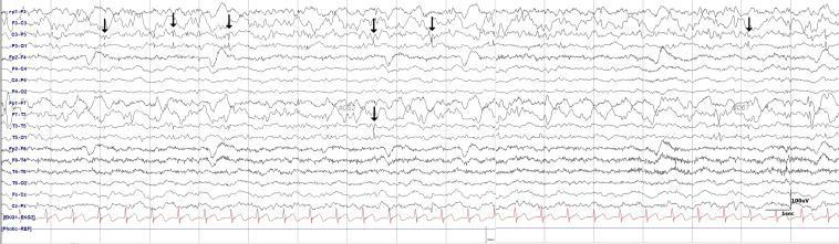 Min-Hee Woo, et al. Hydrocephalus Mimicking Status Epilepticus 51 mental drowsiness continued for more than 30 minutes.