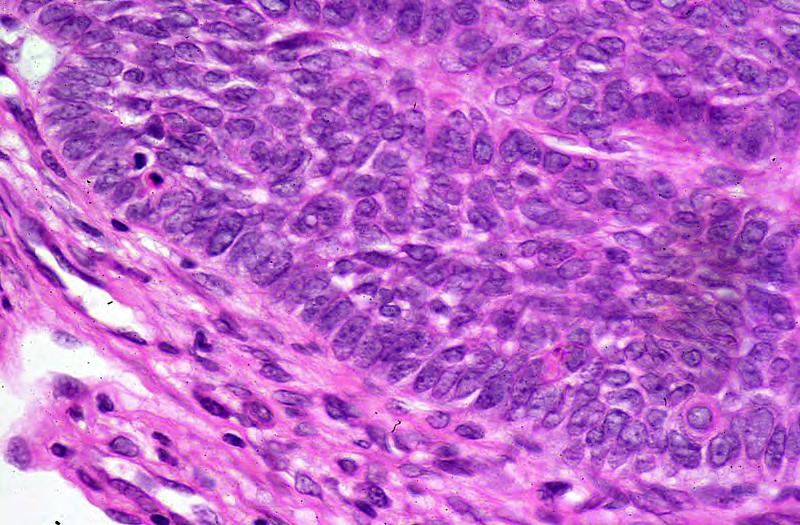 Tumour Stroma Basal cell carcinoma (high power).
