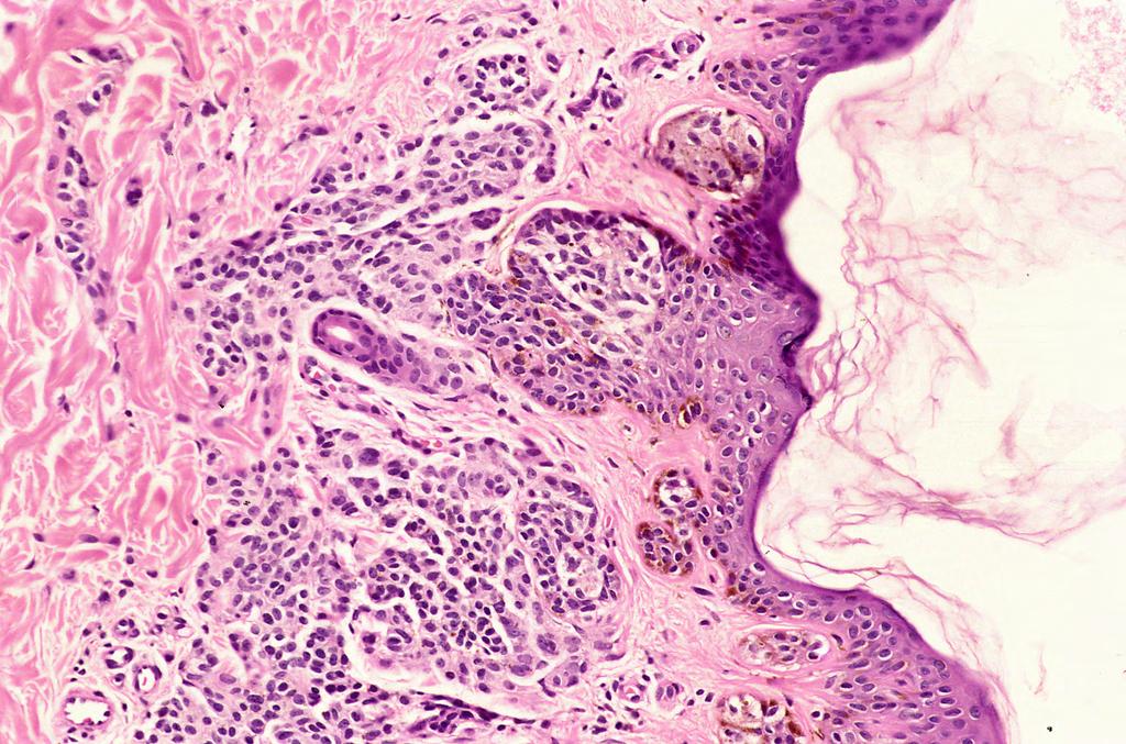 Common types of benign melanocytic naevi generally contain bland naevus cells that are arranged as nests at the dermoepidermal junction and/or nests or sheets in the dermis.