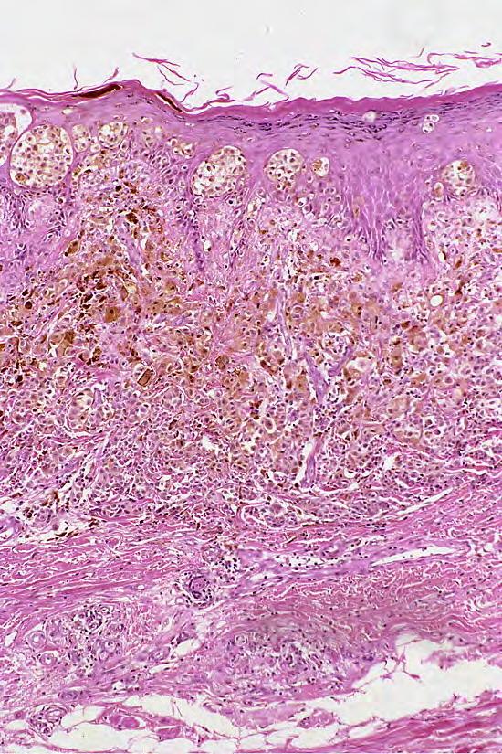 Invasive malignant melanomas contain melanocytes that are generally arranged as nests at the dermoepidermal junction and/or nests or sheets in the dermis. The cells however are atypical.
