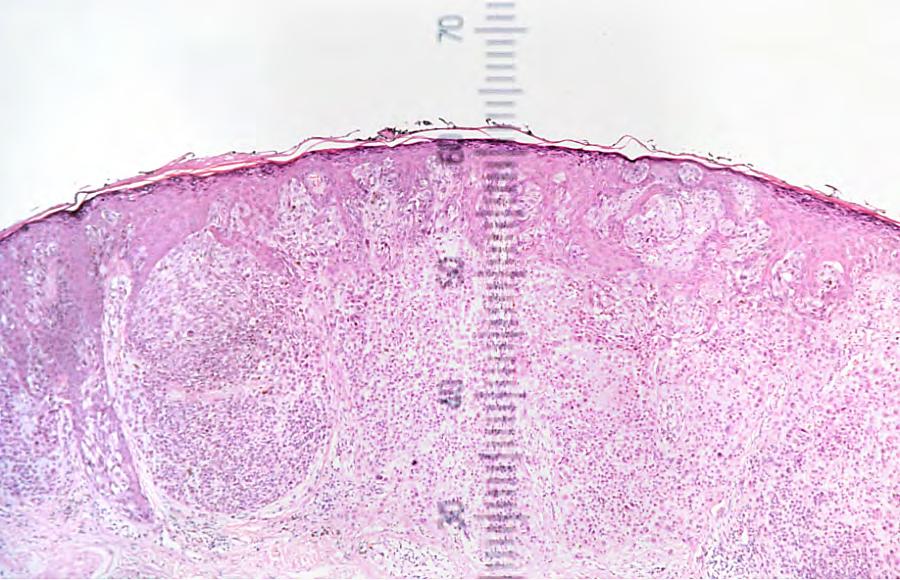 In the absence of metastases, the prognosis of melanoma is mainly dependent on the depth of invasion into dermis measured in mm from the overlying
