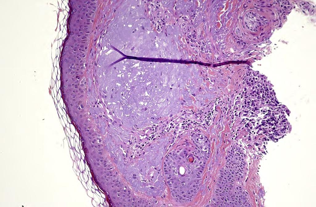 Skin, solar elastosis. Note the greypurple discolouration (it should be eosinophilic) of the dermal connective tissue (black star).