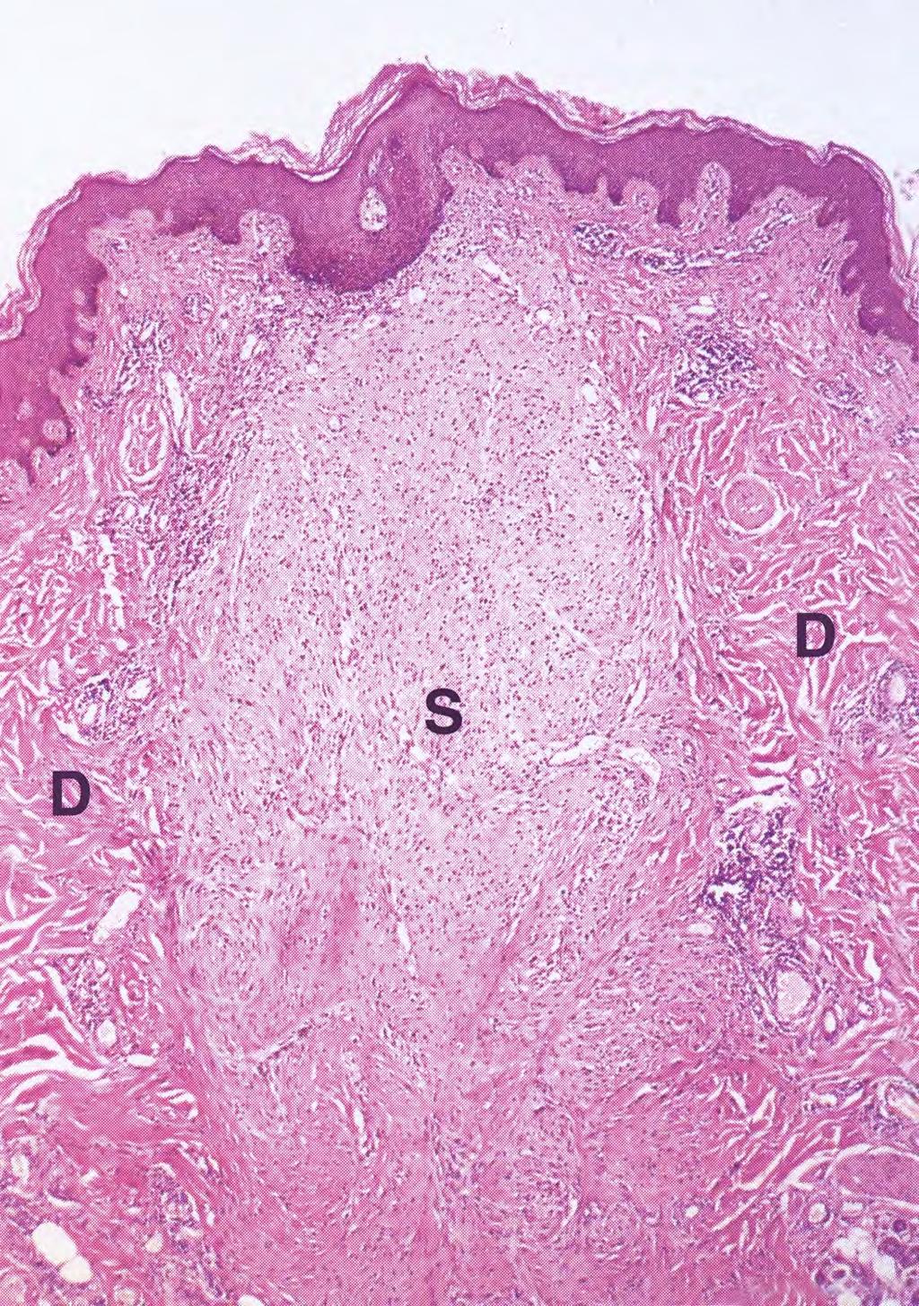Skin, early fibrous scar (S) with normal dermis (D) on either side, low power.