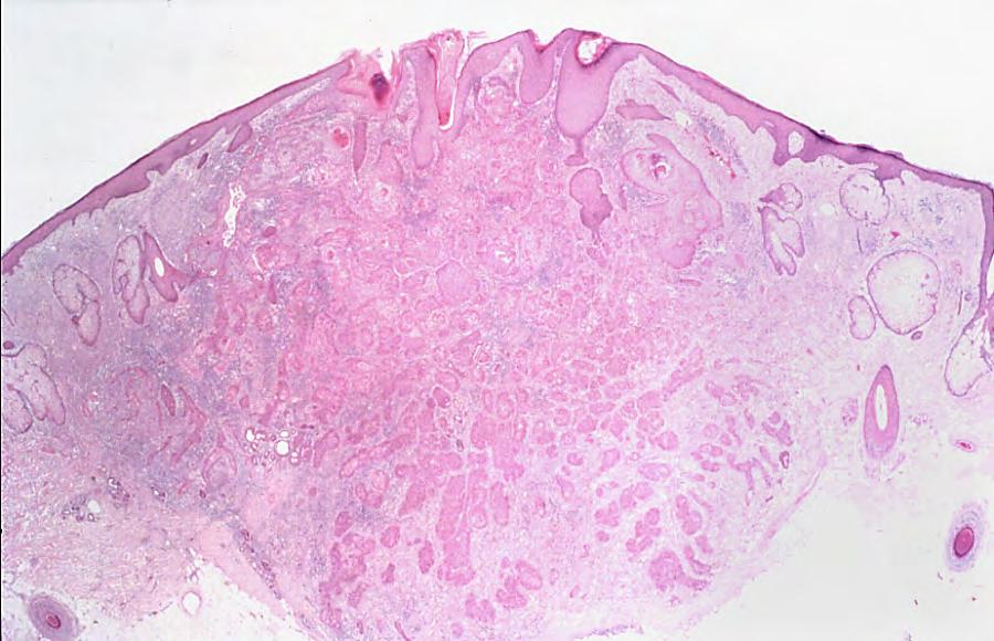 Squamous cell carcinoma (outlined by blue lines) invading through dermis into subcutaneous tissue (very low power view). Origin from the epidermis is not always readily seen.